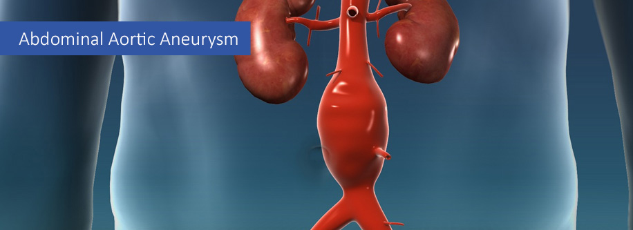 Abdominal-aortic-aneurysm
